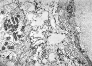 F,7y. | ependymoma- multilayered endothelial basement membrane F,7y. | ependymoma- multilayered endothelial basement membrane